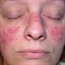 People with rosacea may be at higher risk for Alzheimer's
