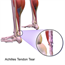 Partial or total rupture of Achilles tendon