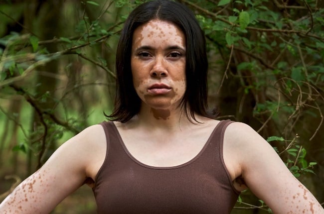 Marian de Vos developed vitiligo after her first Survivor stint. (PHOTO: Mnet)
