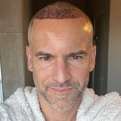 Janez Vermeiren is loving his hair transplant – here's more about the increasingly popular treatment for men