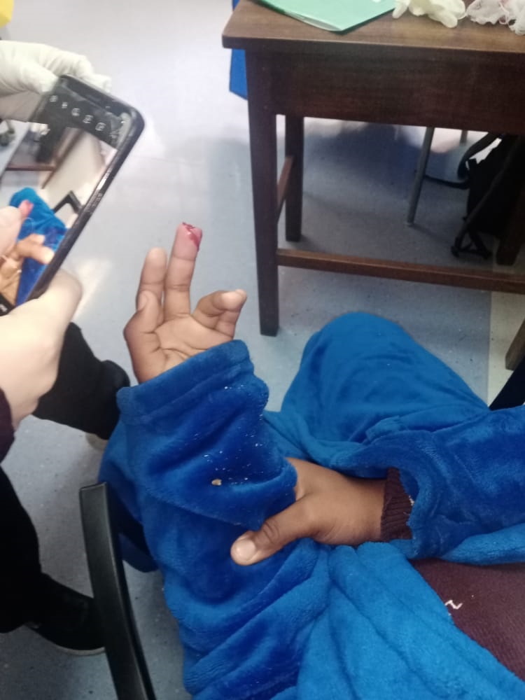 A grade 8 pupil lost the tip of his finger as a result of bullying at school. Photo: Supplied