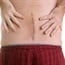 Spinal fusion not always necessary for back pain