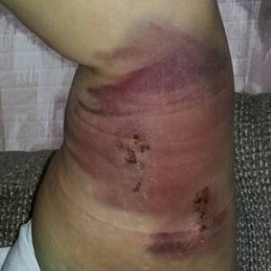 Amanda's arm after the Implanon device was removed.Source: Facebook