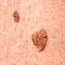 New melanoma drug significantly extends survival time