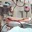 The potential danger of catheters used in dialysis