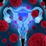 Bacteria in female reproductive tract linked to ovarian cancer