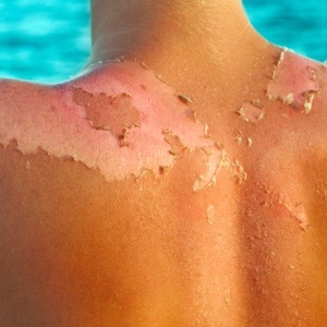 Avoid sunburn to reduce your chances of developing skin cancer. 