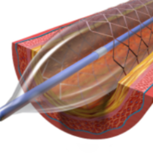 Angioplasty – Google free image
