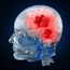 Brain tumours more common in better educated, wealthier people