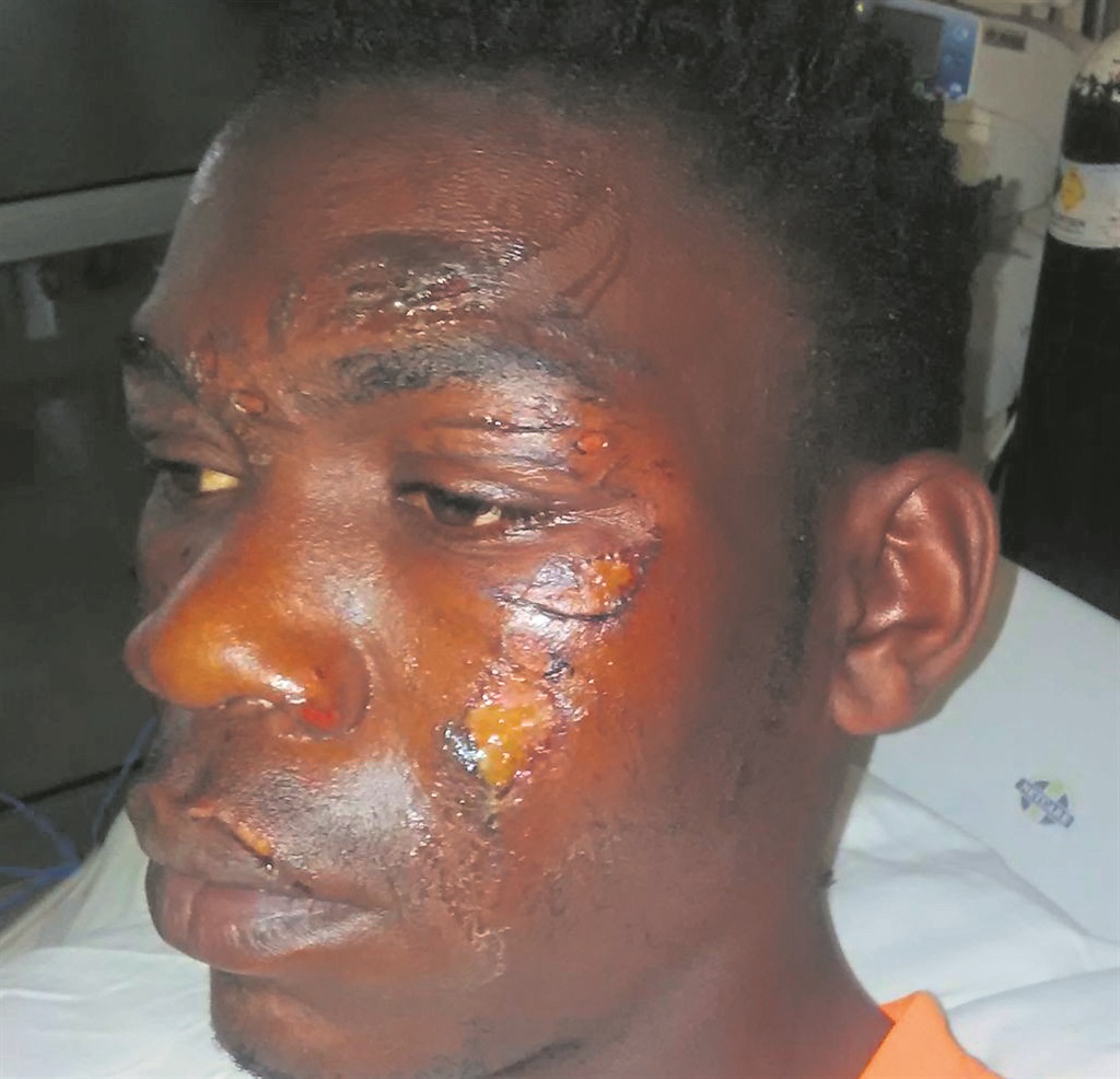 Skhumbuzo Nsele was left with these burn wounds on his face after he was allegedly burnt by his employer.  