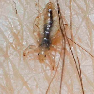 Pictures Of Pubic Lice 49