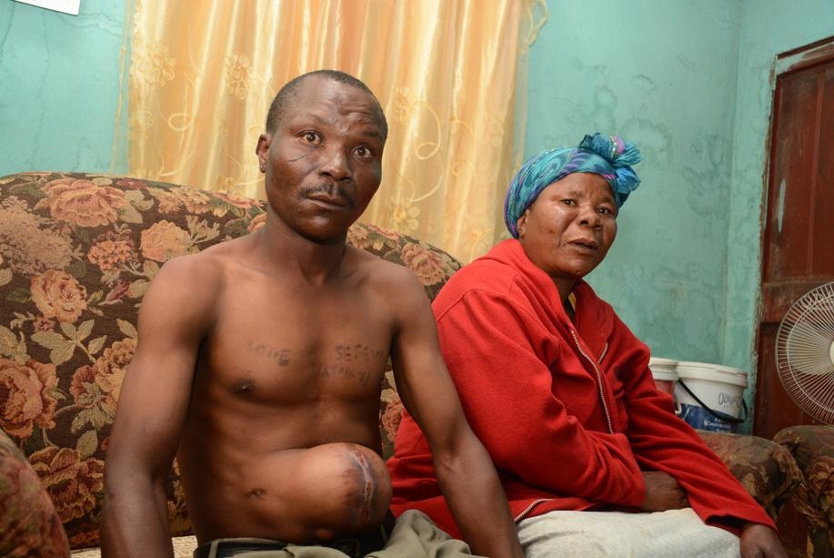Caption Marcus showing the swollen operation on his stomach, while his mother Betty Mahasha worried her son will die of the pains he?s suffering from the operation. Photos by Joshua Sebola