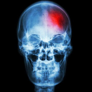 Some factors can increase your risk for post-stroke bleeding.
