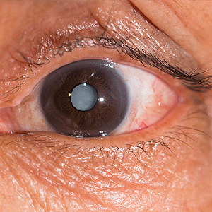 Close up of a cataract