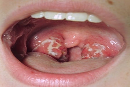 person with strep throat