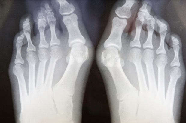 Wearing high heels might affect women's bone health: Survey