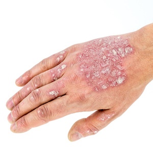 It's common for psoriasis to flare up on the hands, but it can cover larger areas of skin.