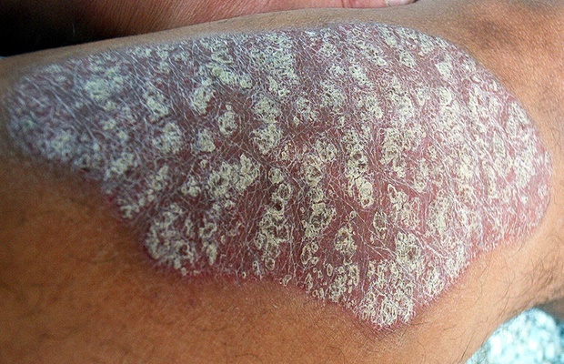 Severe Psoriasis Linked To Earlier Death Health24