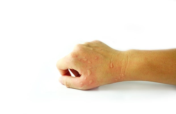 hand with hives