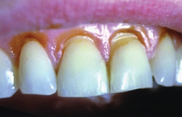 Damage caused to teeth from abrasion