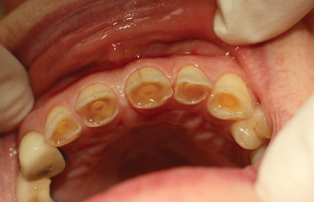 Damage caused by teeth grinding