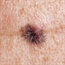 Scientists find a way to block melanoma spread