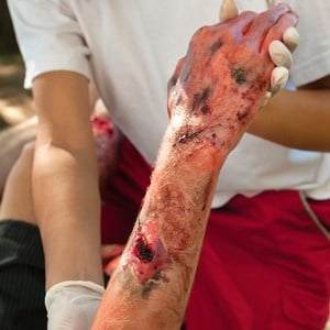 A man with 95% of his body covered in burn wounds was saved by a skin transplant. 