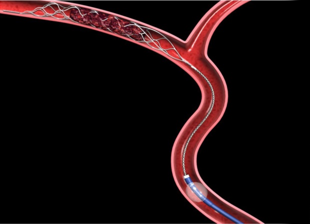 stent remover used in mechanical embolectomy