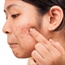 How normally harmless skin bacteria can cause acne