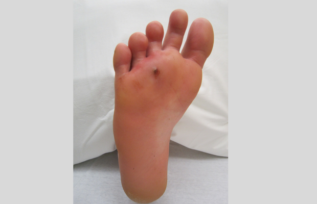 puncture wound in foot 