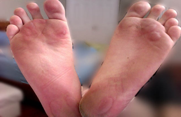 blisters on feet 