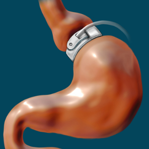 Bariatric surgery – Google free image