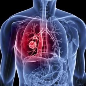 Lung cancer 