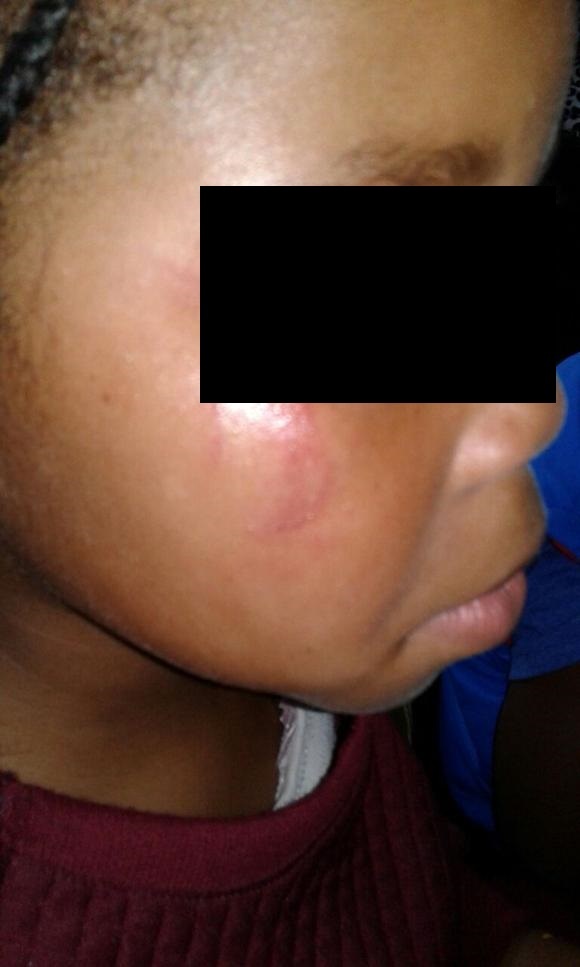 A grade 1 pupil claims she was beaten by her teacher because she did not finish her work on time. 