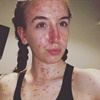 ‘I don’t want to hide anymore’ – young woman with psoriasis learns to embrace her skin