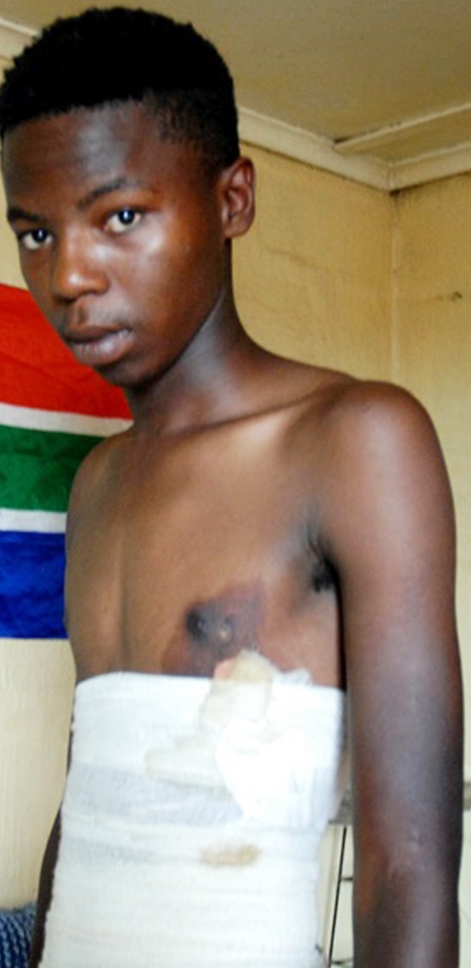 Siphosethu Bucwa claims he had boiling water poured over him when a cellphone went missing.      Photo by   Chris Qwazi 