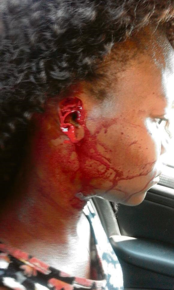 IT’S GONE: This is all that was left of Thando’s ear after a fight with her uncle’s wife. 