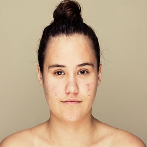 We often have little control over the causes of acne. 