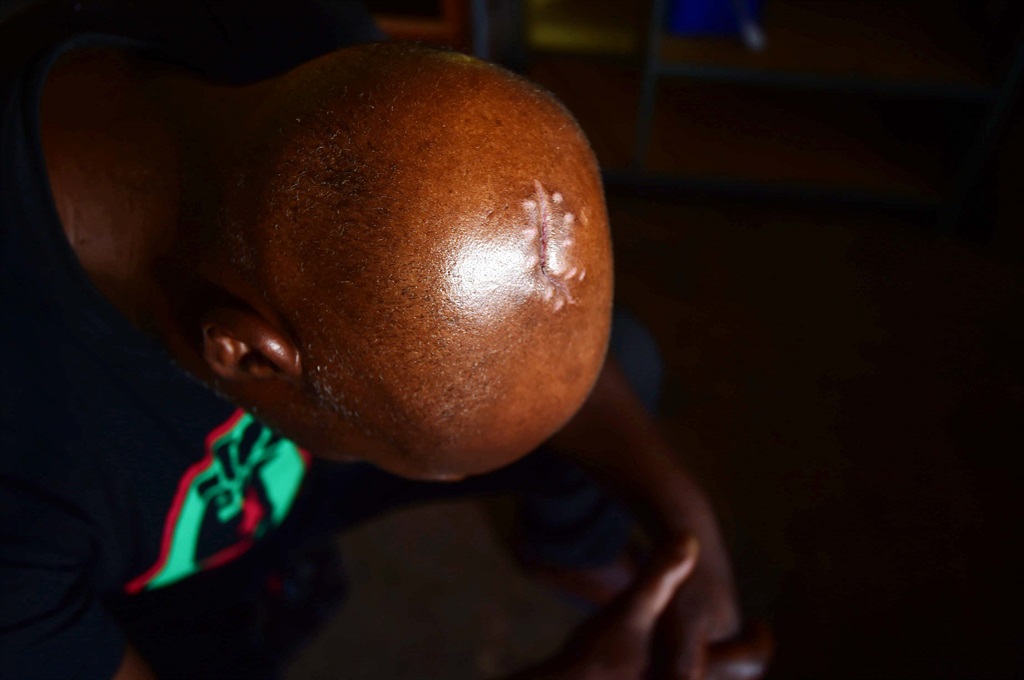 Mandla Ngcobo (53) from Mofolo south in Soweto said thugs hacked him and a friend who came to visit him..Photo by Lucky Morajane Photo by   