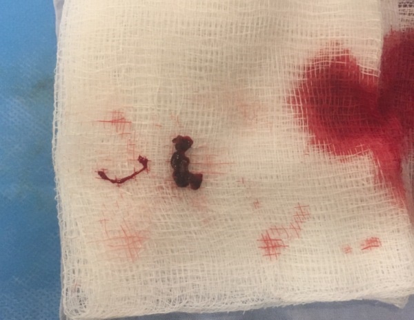 clot removed from Geralds brain