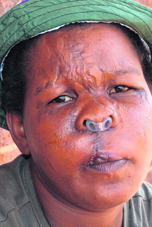 Scarred Hlengiwe Lembede believes her dead boyfriend is fighting her battles from beyond the grave.        Photo by      Everson Luhanga