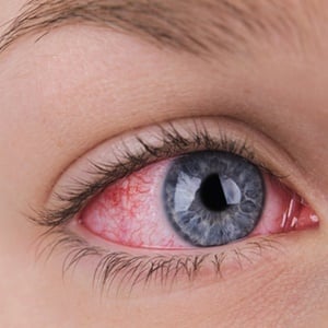 Allergies can be easy to spot if you know the symptoms. 