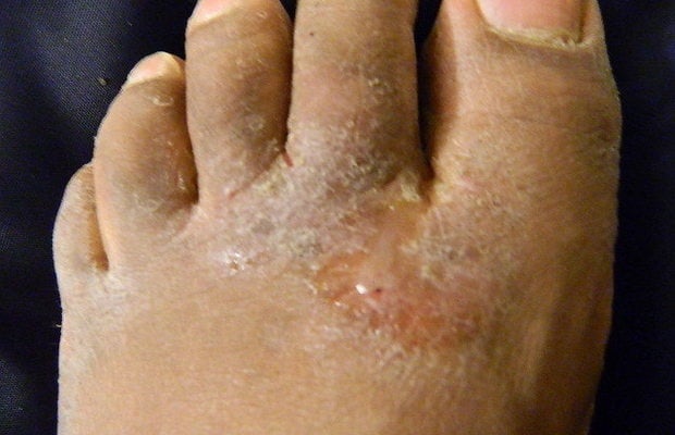 athlete's foot between toes