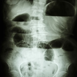 An x-ray showing signs of bowel obstruction: dilated bowel loops and air-fluid levels. (See article for explanation)