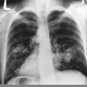 This is an x-ray image of a chest. Both sides of the lungs are visible with a growth on the left side of the lung, which could be lung cancer. Source: National Cancer Institute