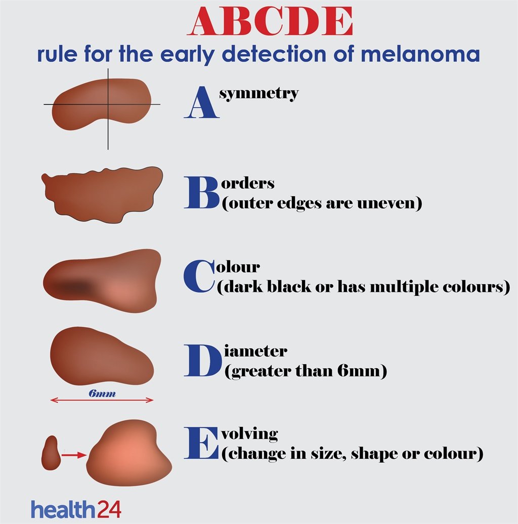 skin cancer, ABCDE, infographic, melanoma