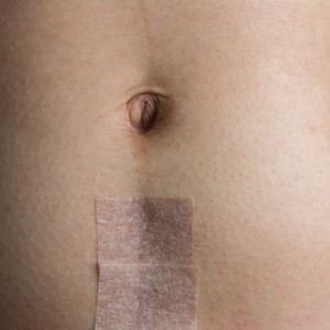 C-section scar from Shutterstock