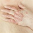 Injuries up the risk of psoriatic arthritis in people with psoriasis