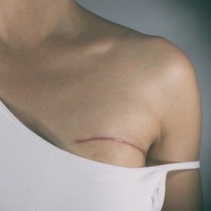 Scar after breast tumour surgery
