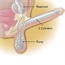 Less prosthetic penis implants for erectile dysfunction